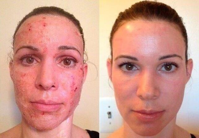 before and after partial skin rejuvenation photo 1