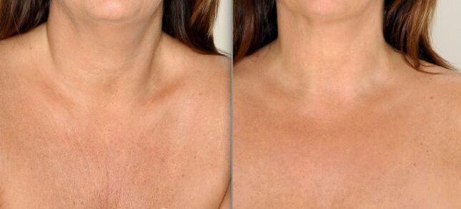 before and after partial skin rejuvenation photo 2