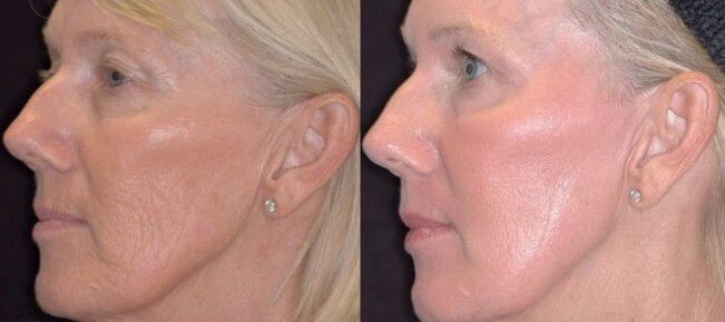 before and after partial skin rejuvenation photo 3