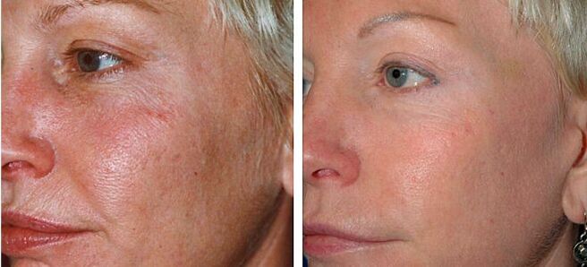 before and after partial skin rejuvenation photo 4