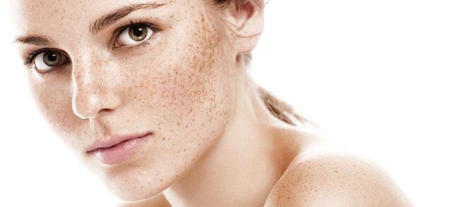 freckles as an indication of partial rejuvenation