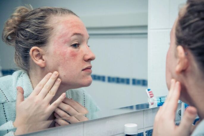 Chronic skin diseases in the worsening stage