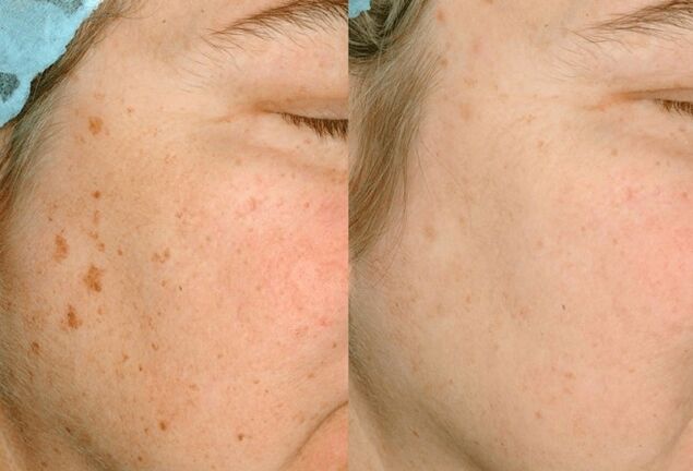 Removing pigmentation on the skin