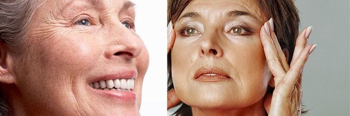Expressive wrinkles and age-related changes