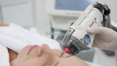 How fractional skin rejuvenation is performed